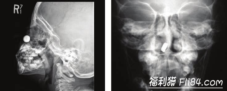 2019年《老美往某穴插入的异物种类》统计 人们到底是多爱往洞里塞圣诞节装饰物啊