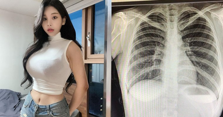 【捕鱼王】南韓「百萬網紅」不滿被質疑整形…曬 X 光照自證清白：我沒有動過手術